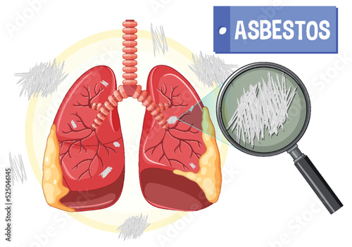 Diagram showing asbestosis in lungs