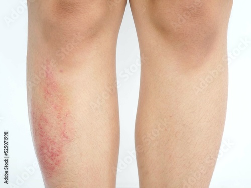 Asian woman have bruise on right leg from accident on white background. Closeup photo, blurred.