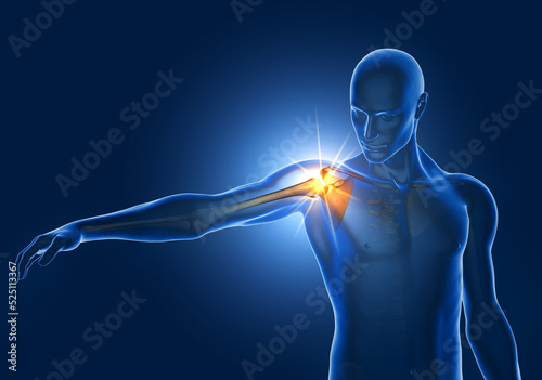 Shoulder Impingement, Painfull Arc, 3D Illustration photo