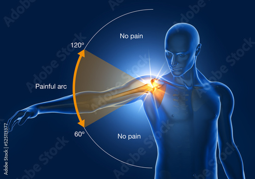 Shoulder Impingement, Painfull Arc, 3D Illustration photo