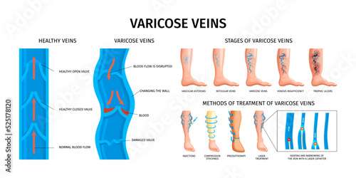 Varicose Veins Realistic Infographics
