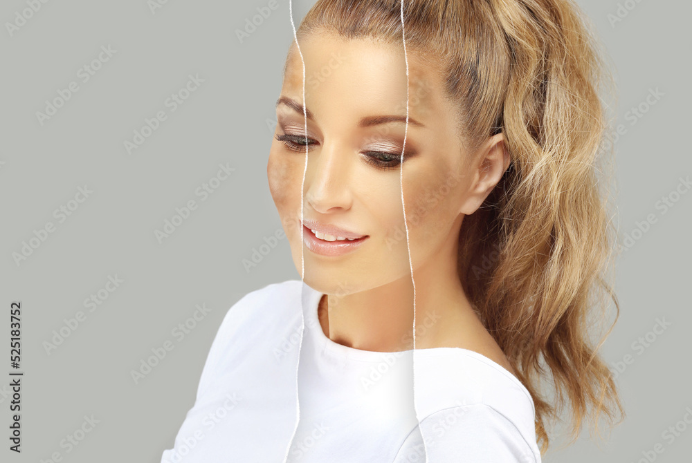 Dark spots, freckles,hyperpigmentation(melasma or chloasma),concept - skin lightening, skin whitening, fruit acids,AHA, Skin Brightening Dark spots, freckles,hyperpigmentation(melasma or chloasma),concept - skin lightening, skin whitening, fruit acids,AHA, Skin Brightening