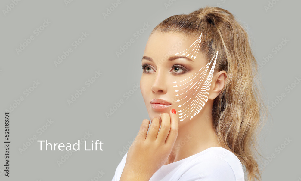 Thread Lift ,markup, threadlift procedure for facial rejuvenation., obrazy, fototapety, plakaty