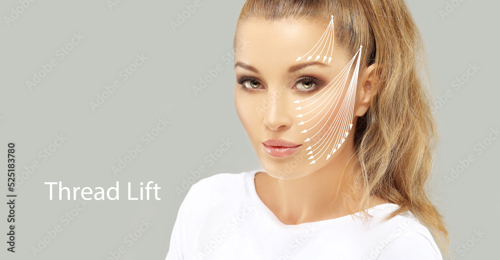 Thread Lift ,markup, threadlift procedure for facial rejuvenation