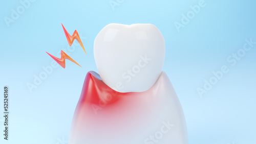 Gums gum inflammation, gingival recession. Dental treatment concept. 3D rendering. photo