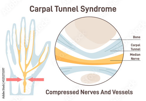 Carpal tunnel syndrome. Compressed median nerve. Carpal tunnel anatomy