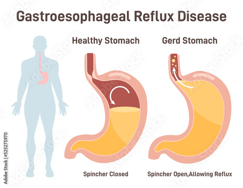 Heartburn or Gastroesophageal Reflux Disease. Stomach acid photo