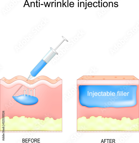Anti-wrinkle injections. aesthetic procedure.