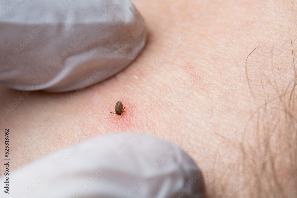 Sucking tick Macro photo on human skin. Ixodes ricinus. Bloated ...
