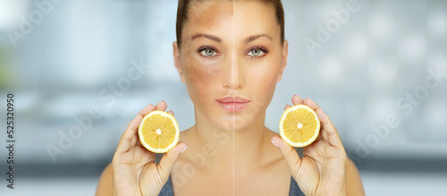 Картината върху платно Dark spots, freckles,hyperpigmentation(melasma or chloasma),concept - skin light
