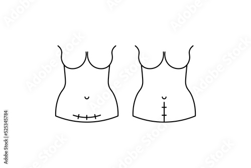 C-section scar on woman's abdomen. Vertical and horizontal. Vector illustration. Minimalism.