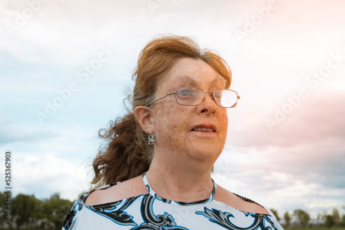 woman with burn scars smiles outdoors at sunset