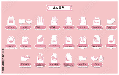 爪の異常・病気のイラスト