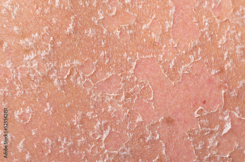 Sunburn, close-up of human skin. Flaky skin from allergies, peeling or eczema. Dry skin in need of treatment and hydration.