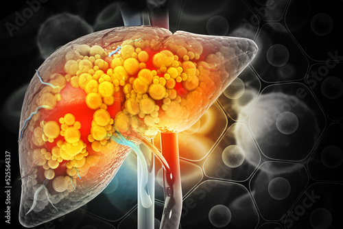 Liver damage such as Fatty liver, Fibrosis, Cirrhosis, and Liver cancer. 3d illustration photo