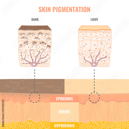 Comparison of melanosomes distribution in dark and light skin. Pigmentation mechanism in different skin phototypes infographics. Close up of epidermis cross-section. Vector medical illustration. photo