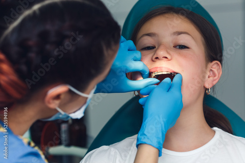 dentist installs braces for a girl child. The concept of dentistry, dentistry and orthodontics.