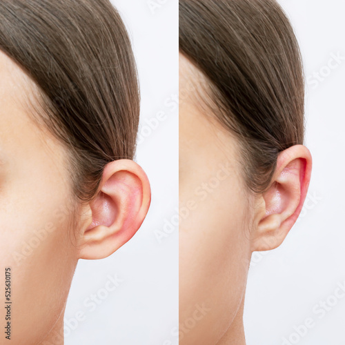 Cropped shot of young woman's head with ears before and after otoplasty on a white background. Result of cosmetic plastic surgery of correction auricles and getting rid of lop - eared
