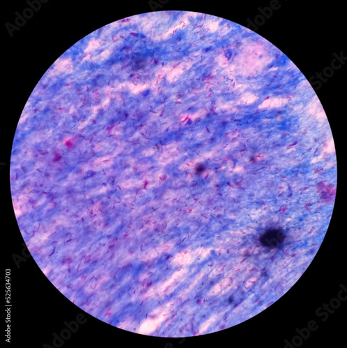 Microscopic 100x image of AFB stainig. Microbacterium Tuberculosis Bacteria (MTB). Sputum or phlegm smear.