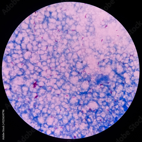 Microscopic 100x image of AFB stainig. Microbacterium Tuberculosis Bacteria (MTB). Sputum or phlegm smear. photo