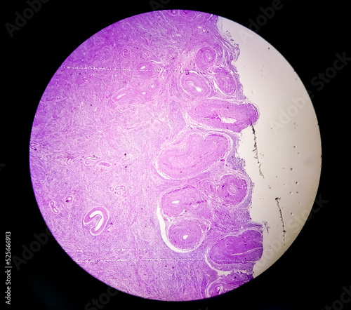 Histological examination of uterus biopsy suggestive uterine prolapse. Chronic cervicitis with prolapse.