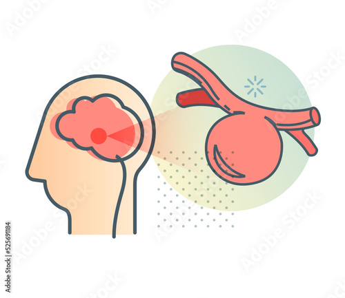 Aneurysm buildup over a period of time - Stock Icon