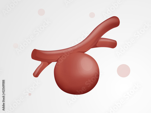 Aneurysm buildup over a period of time - Stock Icon