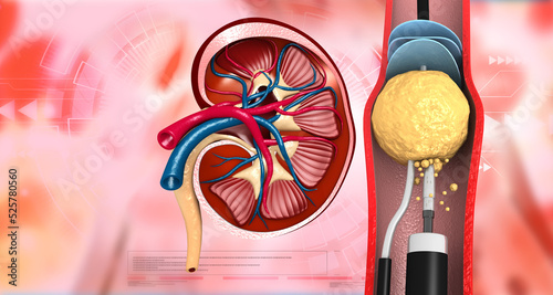 Human kidney stone removal. 3d illustration.. photo