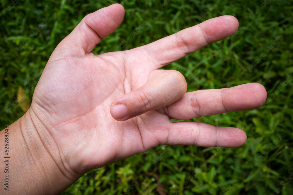 Trigger Finger lock on middle finger of woman's front left hand