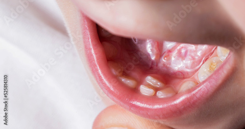 A child's tooth grows second next to the milk teeth. Formation of the jaw and permanent teeth in children. Removal of milk teeth, close-up photo