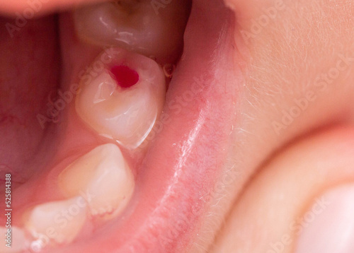 Installation of a colored red filling in a milk tooth for a child. Colored fillings in dentistry for children. Treatment of pulpitis and deep caries, close-up
