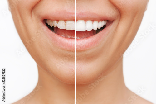 Cropped shot of a young caucasian smiling woman before and after veneers are installed isolated on a white background. Teeth whitening. Dentistry, dental treatment. The result of veneers installation photo