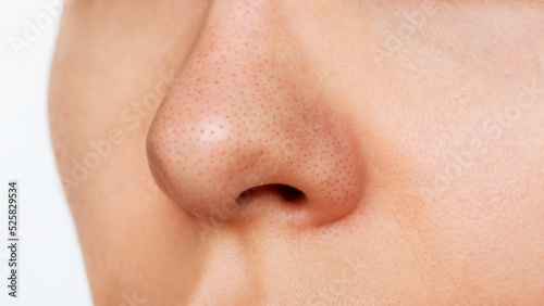 Close-up of a woman's nose with blackheads isolated on a white background. Acne problem, comedones. Enlarged pores on the face. Cosmetology dermatology concept. Black dots on the female nose