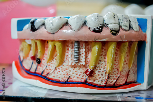 mouth construction model with root canals to show how tooth implant works.