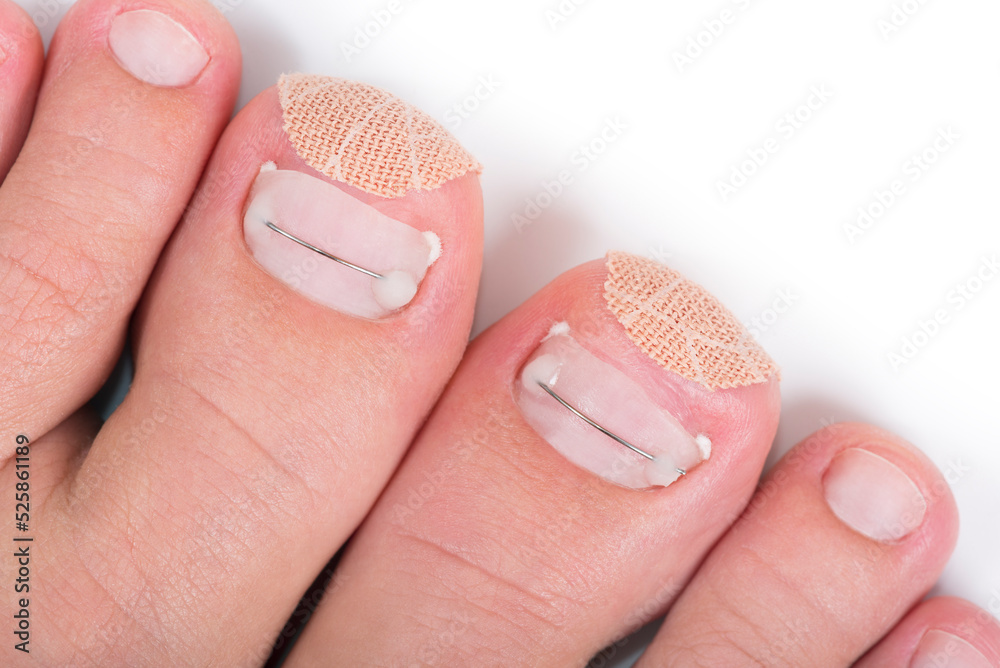 Titanium thread and kinesiology tape medical treatment on a toenails of feet. Close-up. Isolated on white background. Podology and chiropody concept. - obrazy, fototapety, plakaty 