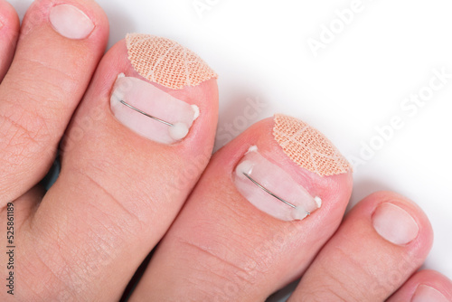Titanium thread and kinesiology tape medical treatment on a toenails of feet. Close-up. Isolated on white background. Podology and chiropody concept.