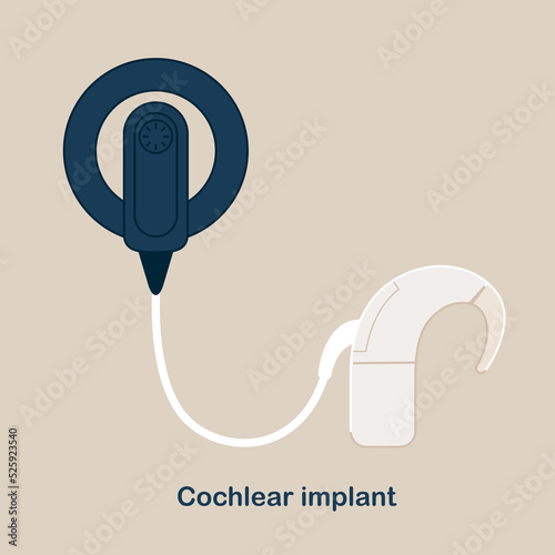 Cochlear Implant Vector illustration. Hearing therapy concept. World Deaf Day in last Sunday of September. photo