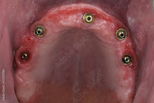 excellent gingival cavity of the upper jaw with a prosthesis for fixing the prosthesis