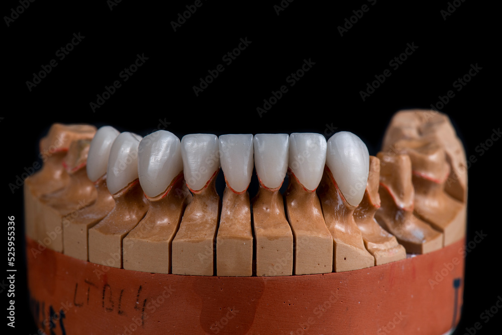 dental job photography, crowns veneers implants
