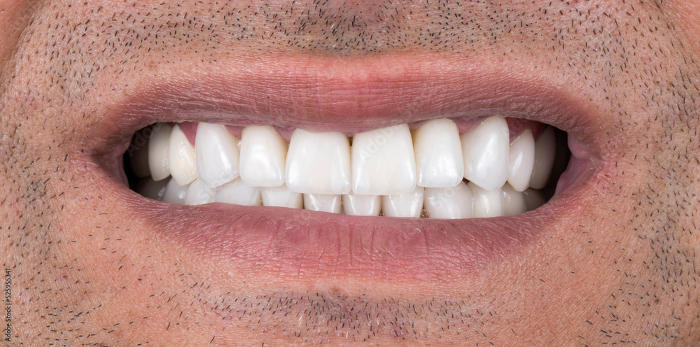 Obraz premium dental job photography, crowns veneers implants