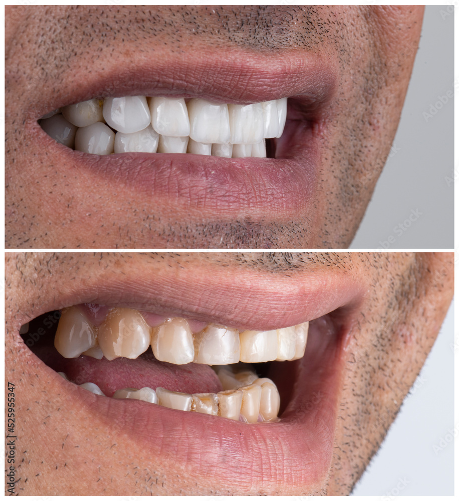 Obraz premium dental job photography, crowns veneers implants