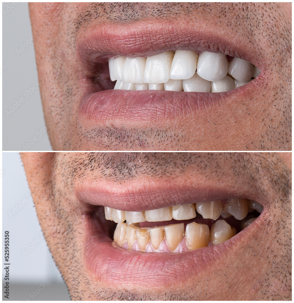 Obraz premium dental job photography, crowns veneers implants