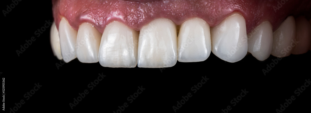 dental job photography, crowns veneers implants
dental job photography, crowns veneers implants