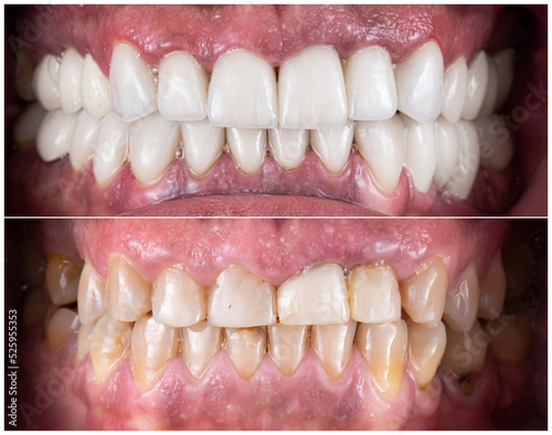 dental job photography, crowns veneers implants 