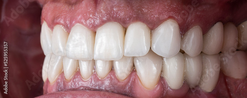 dental job photography, crowns veneers implants 