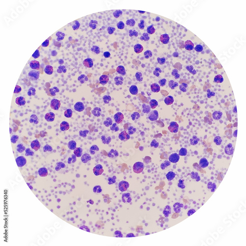 Buffy coat smear shows marked eosinophilia. Eosinophils are a type of disease-fighting white blood cell. This condition most often indicates a parasitic infection, an allergic reaction or cancer.