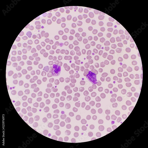 The peripheral blood smear shows eosinophil, basophil, erythrocytes and thrombocytes.  Eosinophils and basophils are important effector cells in human allergic diseases. photo