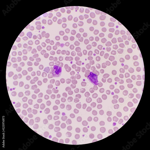 The peripheral blood smear shows eosinophil, basophil, erythrocytes and thrombocytes.  Eosinophils and basophils are important effector cells in human allergic diseases.
