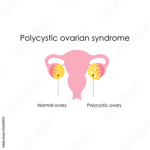 Anatomical drawing. An example of a healthy ovary and an ovary with polycystic.