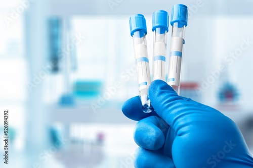 A disease blood test in doctor hand on the background photo
